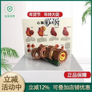 教学仿真血管模型活动血管阻塞模型血栓病变标本4阶段性动脉O硬化