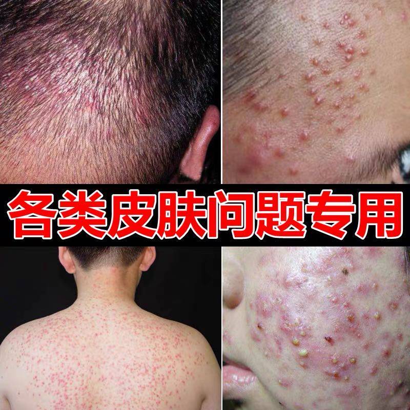 毛囊炎头部疙瘩治疗头皮癣药脂溢性皮炎胸背部手臂腿部毛囊炎药膏