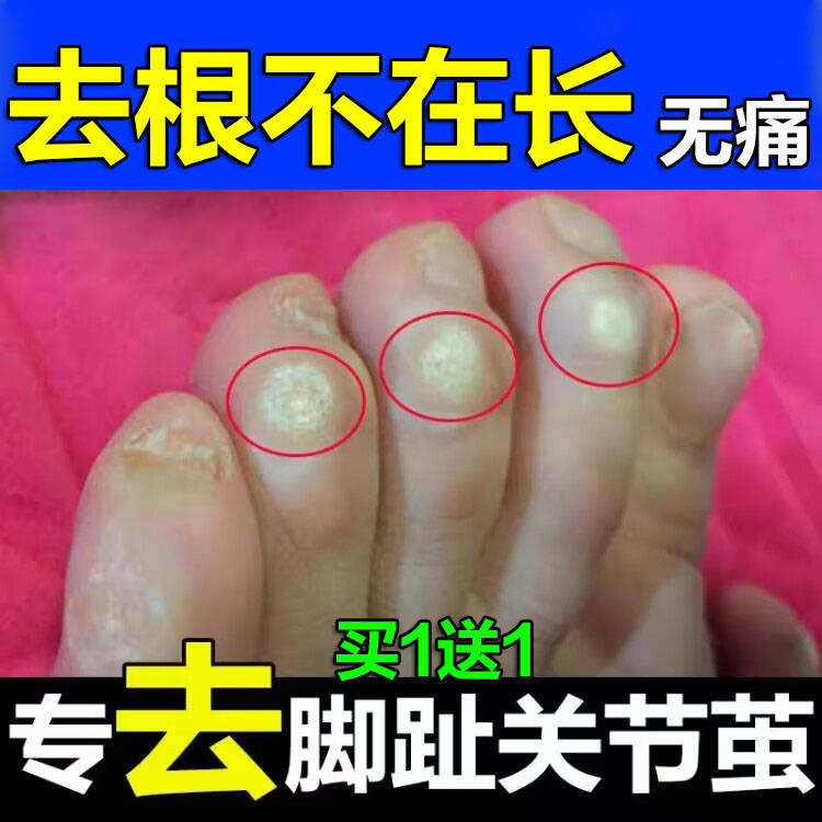 去脚趾头上老茧除厚关节茧子硬死皮神器角质脚垫根鸡茧膏贴软化剂