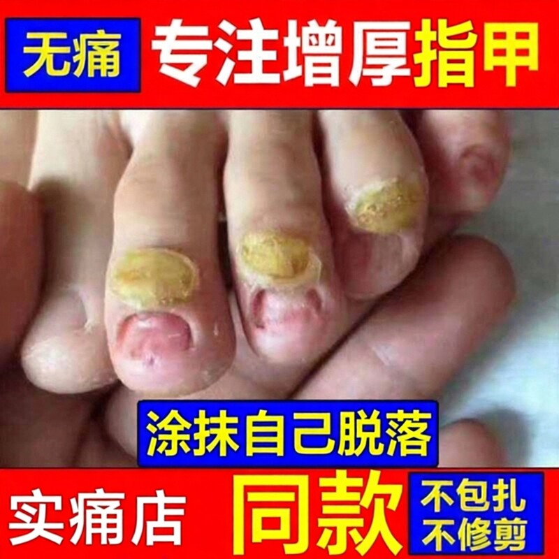 绣医阁脱甲无痛厚指甲涂抹软甲膏