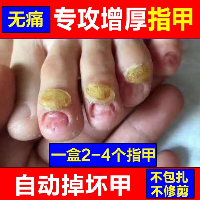 专注趾甲增厚发黄灰甲分层长甲液变厚亮指甲变色分离软甲脱甲精油