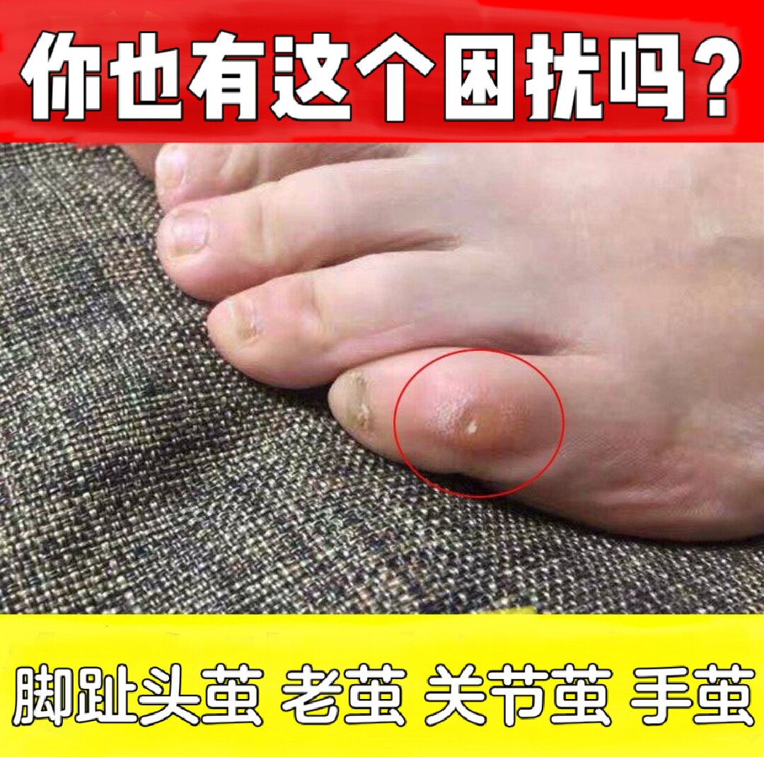 去脚底后跟脚趾头上关节茧厚死皮老茧净肉刺膏软化剂脚垫手足神器