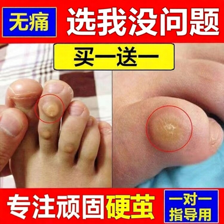 绣医阁茧净老茧脚茧手茧脚垫除脚趾关节茧去死皮老茧膏贴肉刺草本
