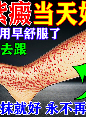 紫癜特效膏药疗治色素过敏性紫癜四肢皮下出血红点瘀斑血管炎专用