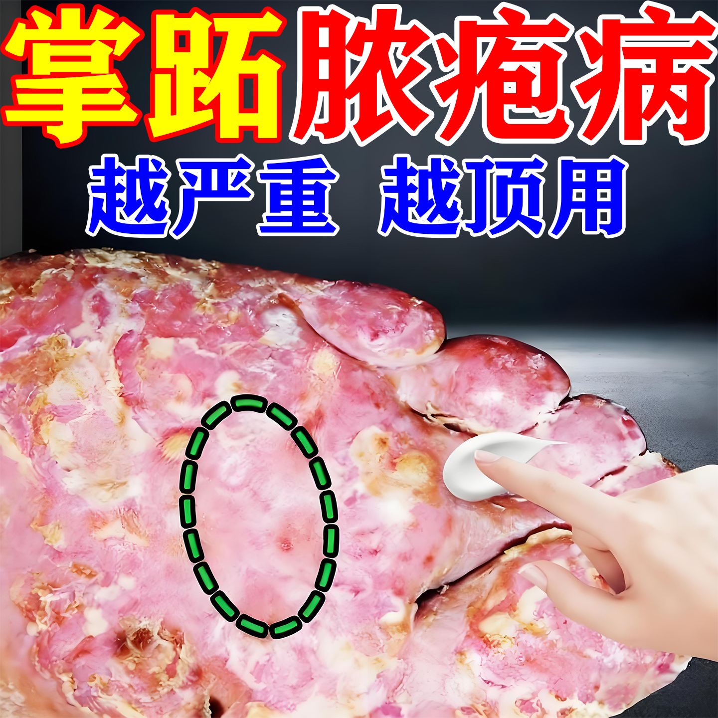 掌跖脓包病红斑干裂蜕皮专用药膏