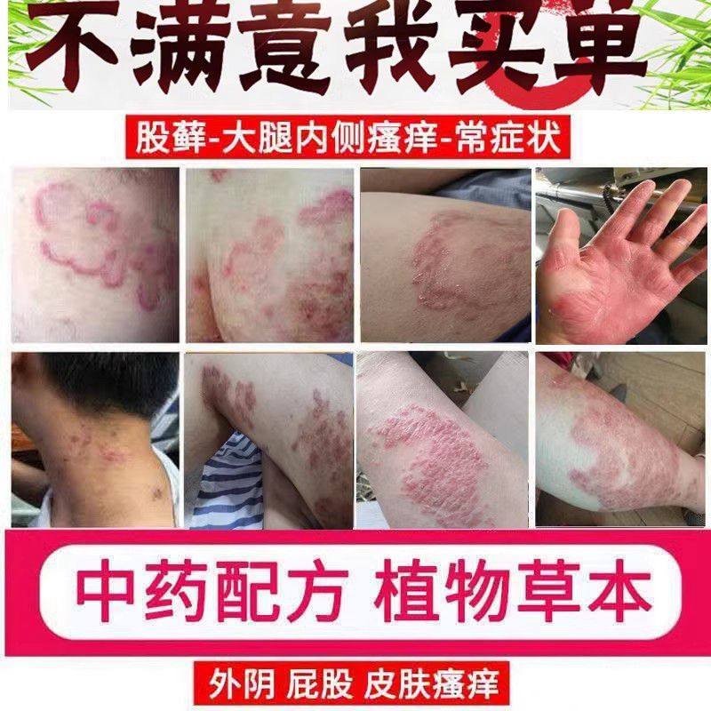 癣药膏手足体股藓皮肤湿疹瘙痒