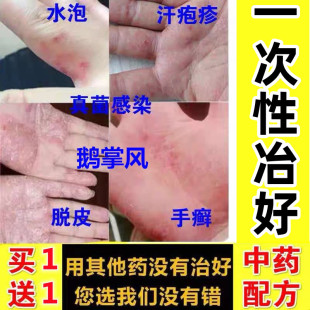 手痒膏湿痒脱皮干裂去手足开裂汗疱手脚脱皮水泡真菌感染药膏