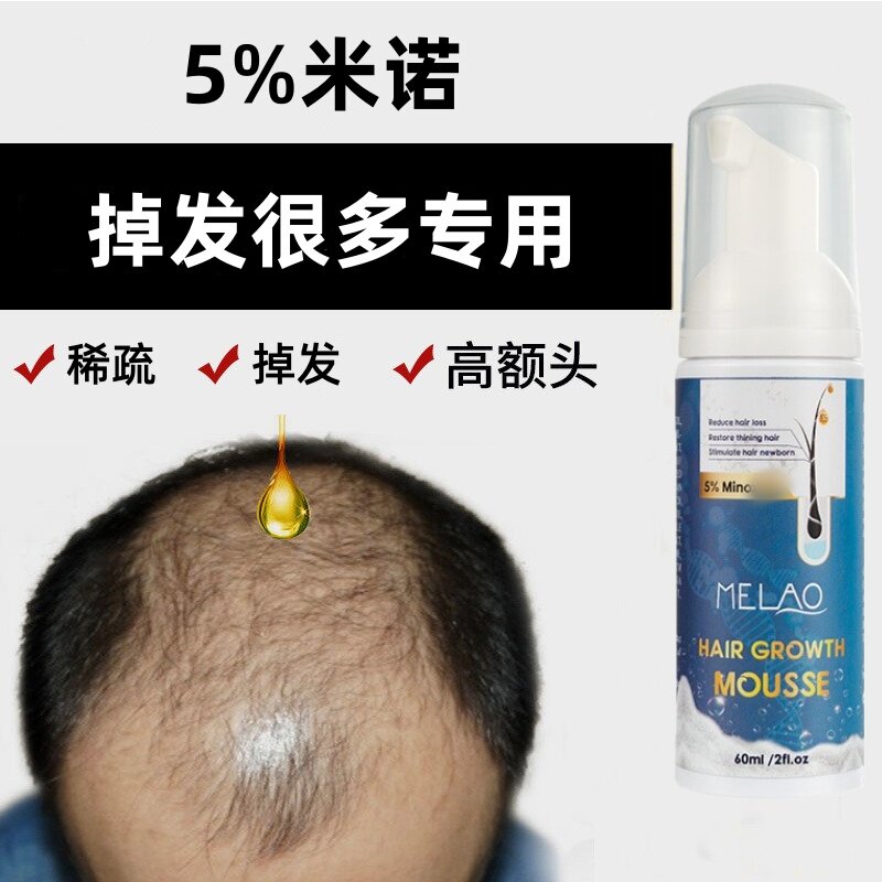 5%米诺密发固发头皮精华液头发增长液营养精油修复屏障防掉发断发