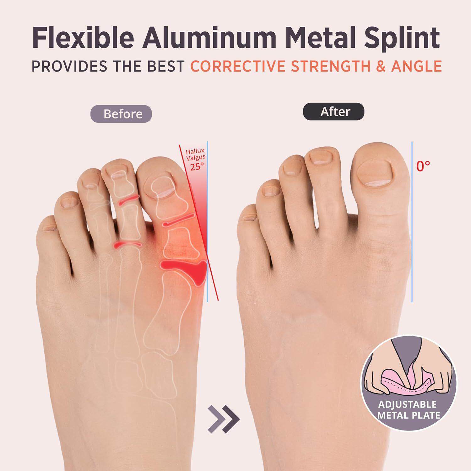 拇指外翻矫形器纠正大母足脚突出分趾神器男女士通用可调节矫正器