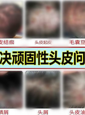 泰国Thailand Dermovate Scalp Water头皮水 老客户回头客链接