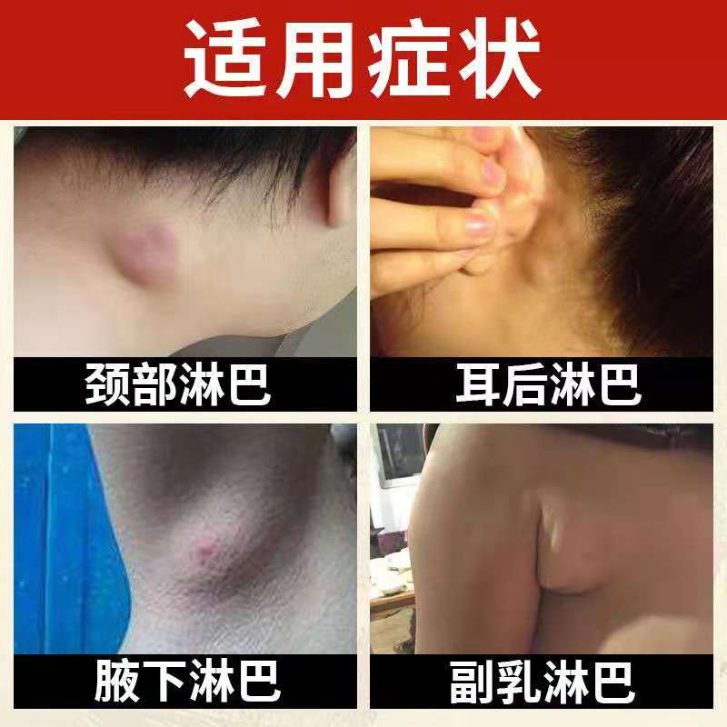 脖子淋巴疏通神器腋下淋巴结消贴肿大散贴膏颈部副乳消除药店