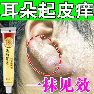治疗耳朵痒的药耳廓干燥起皮外耳道后面湿疹发炎流脓水止痒抑菌膏