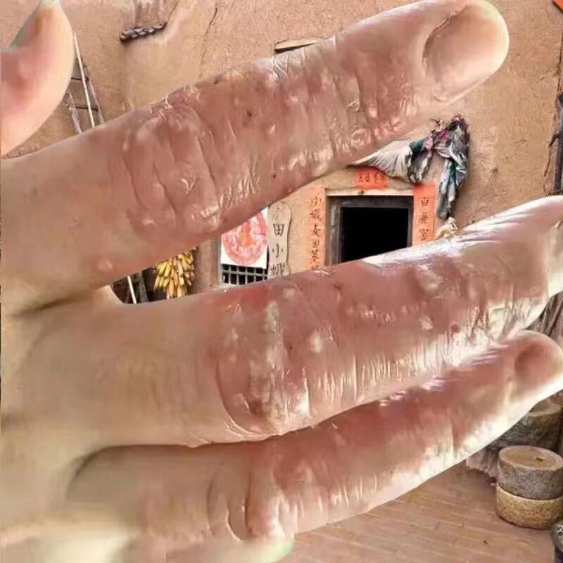 汗疱泡疹手指上长小水泡瘙痒日光性皮炎真菌感染水泡疹湿毒疹软膏