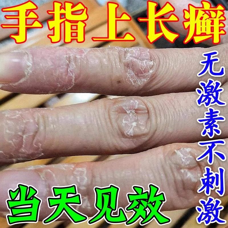 手指关节癣真菌硬皮顽固神经性皮炎关节性牛皮癣关节长癣硬皮药膏