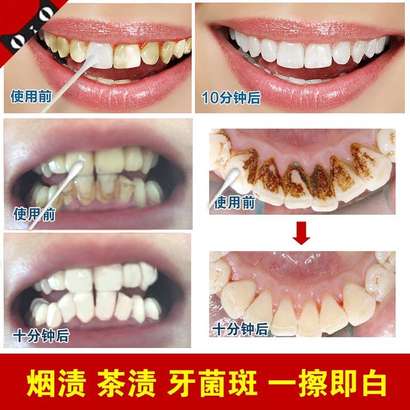 牙粉去黄洗白牙结石去除神器溶解牙膏亮白牙齿美白速效去烟牙茶渍