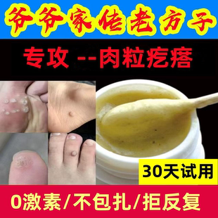 去刺猴小肉粒疙瘩肉刺鱼鳞痣斩除草根脚上鸡茧子眼贴老茧专用神器