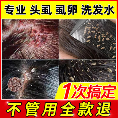 大人儿童百部酊灭头虱洗发水