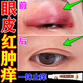 眼皮红肿痒眼睛周围过敏发痒干燥起皮眼角痒神经性皮炎杀菌止痒膏