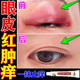 眼皮红肿痒眼睛周围过敏发痒干燥起皮眼角痒神经性皮炎杀菌止痒膏