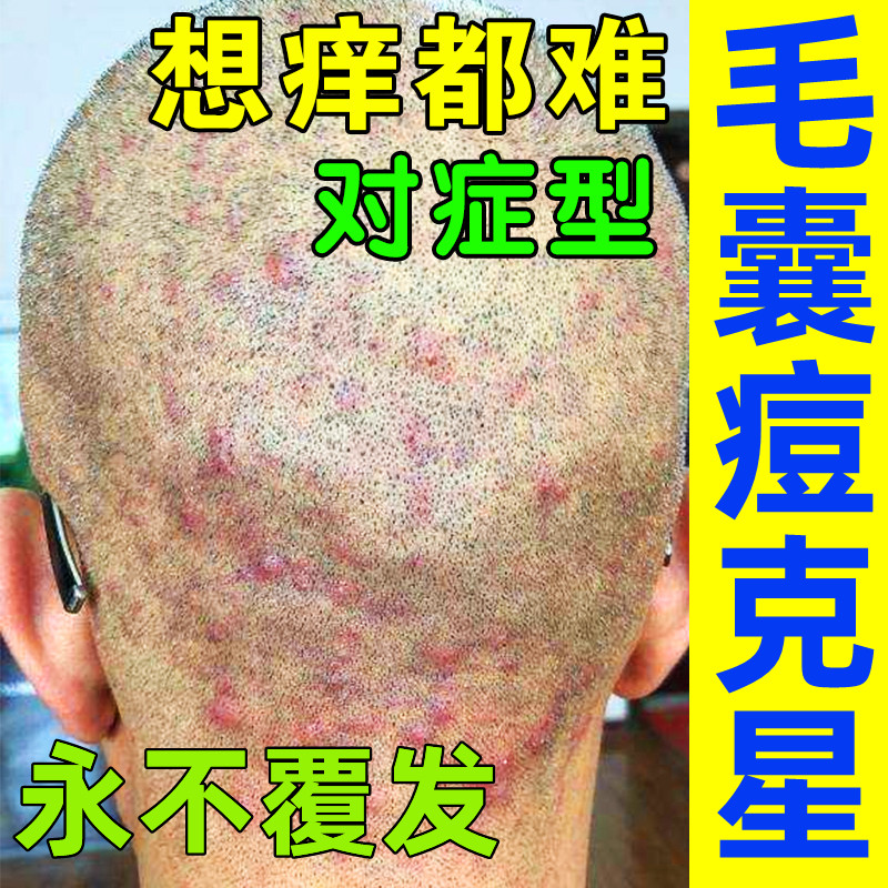 头部头皮痒起疙瘩前胸后背毛囊痘