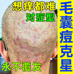 头部头皮痒起疙瘩前胸后背手臂脖子上长痘痘毛囊炎专用膏喷雾剂