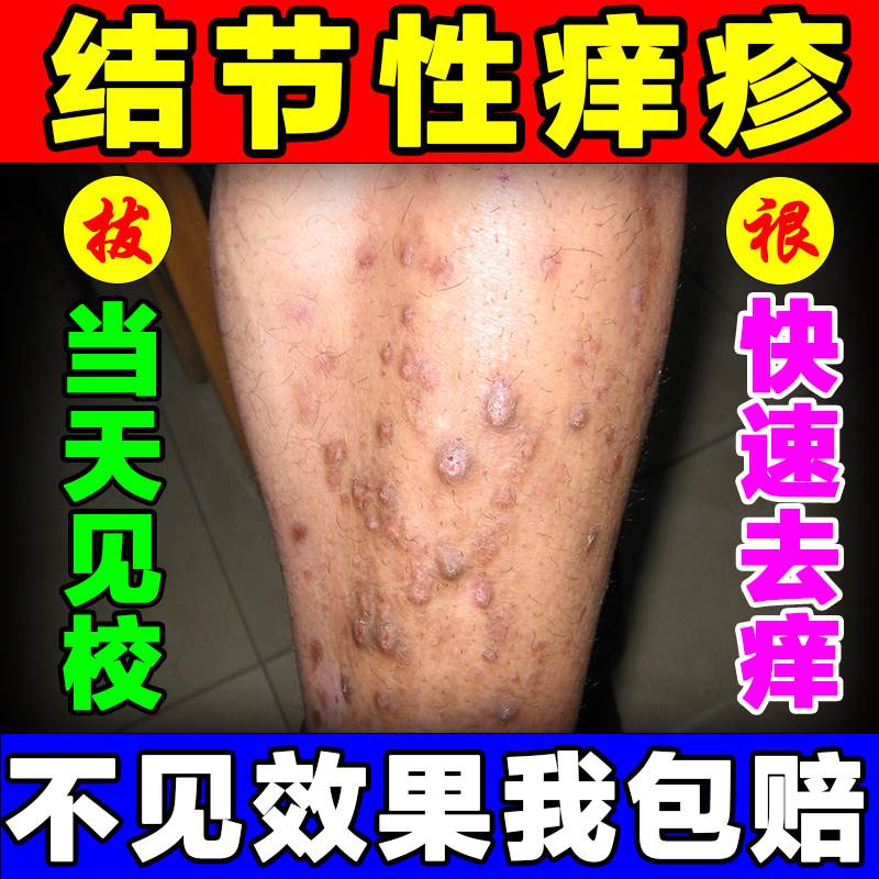结节性痒疹膏【一抹止痒】顽固性剧烈瘙痒止痒神器去