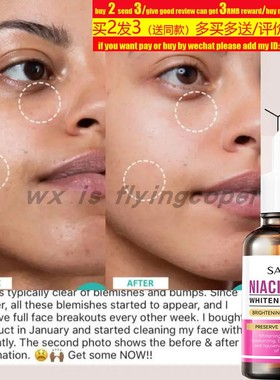 niacinamide Whitening Serum Remove Dark Spots Freckle抗皱液