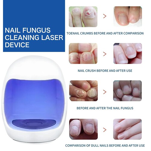 FungalNailLaserDevice