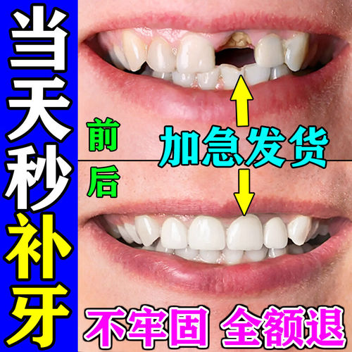 补牙神器自己填充洞膏补牙缝美国进口树脂医在家用瓷粉补牙齿材料
