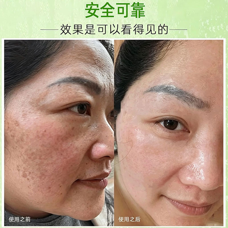 无创溶斑液涂抹水光精华液真皮斑老年斑祛斑液美白原液草本溶斑液