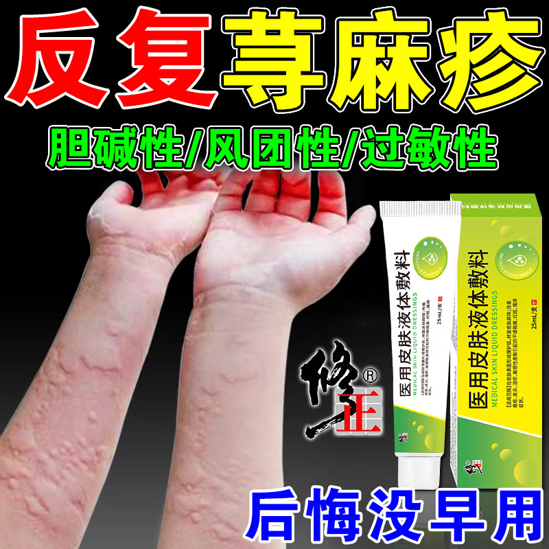 修正荨麻疹过敏止痒断专用根慢性胆碱性丘疹性寻麻疹提高免疫力药