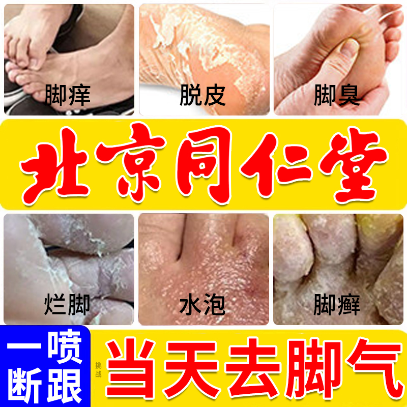 脚气喷雾止脱皮痒杀菌去真菌感染专用糜烂趾缝脚丫除臭汗药房根nx
