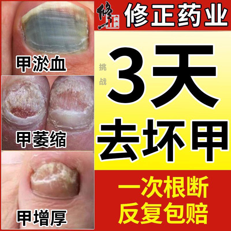 灰指甲根部非治疗脱甲油抑菌液膏房正品旗舰店特?效房sl