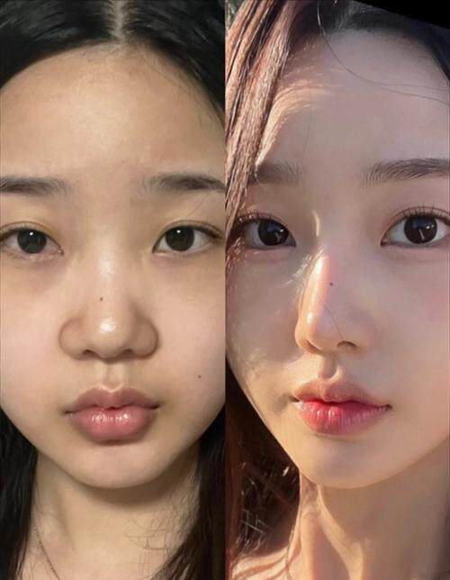 鼻头圆钝修复精华 缩小尖挺改善肥鼻宽鼻精致立体美鼻加强版
