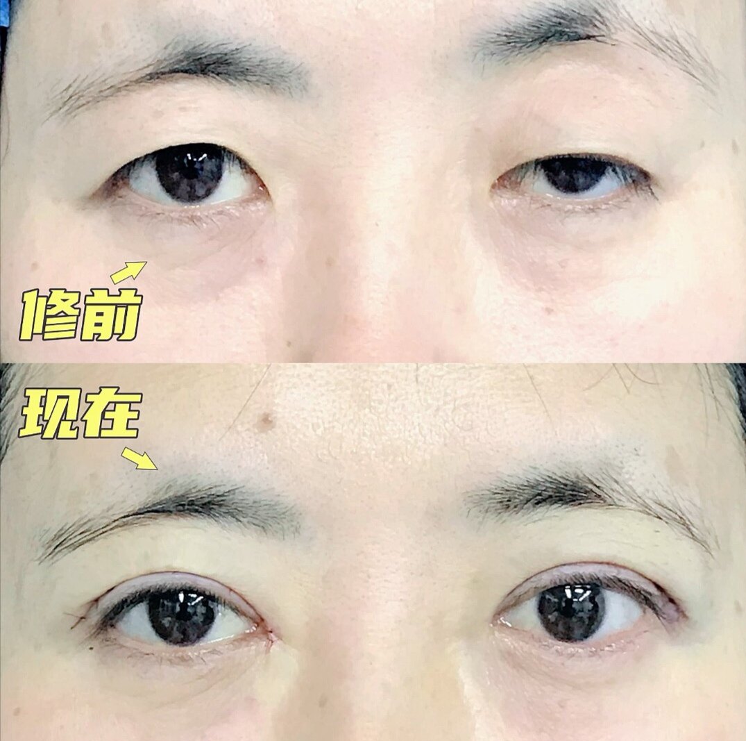 上睑下垂提升内眦修复神器 改善肌无力三角眼修护滋润抗皱加强版