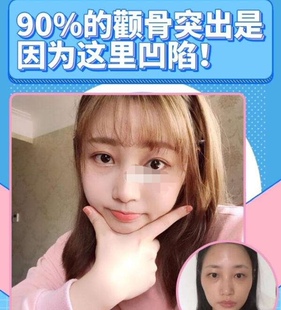 颧骨凹陷修复饱满精华 改善脸骨颧弓外扩突出精油加强版