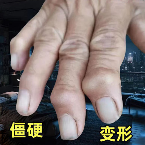 手关节手指腱鞘专用贴膏抹手指粗大变形肿大僵硬关节鼓包修美神器