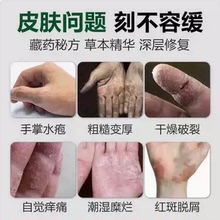 手脱皮严重脱皮专用治疗真菌手脚蜕皮干燥起皮皮肤止痒抑菌的膏药