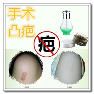 消除脸部伤疤痕灵凝胶修复增生去凸起耳洞肉巴疙瘩遮瑕膏遮盖纹身