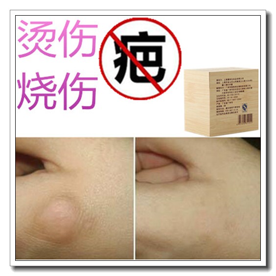 儿童修复膏祛脸烫伤烟疤痕药去增生体质剖宫产线手术凹凸起疙瘩贴