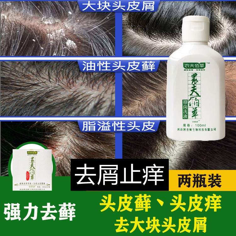 祛大块头皮屑头痒头癣皮牛皮藓毛囊油炎除螨去屑止痒煤焦油洗发水