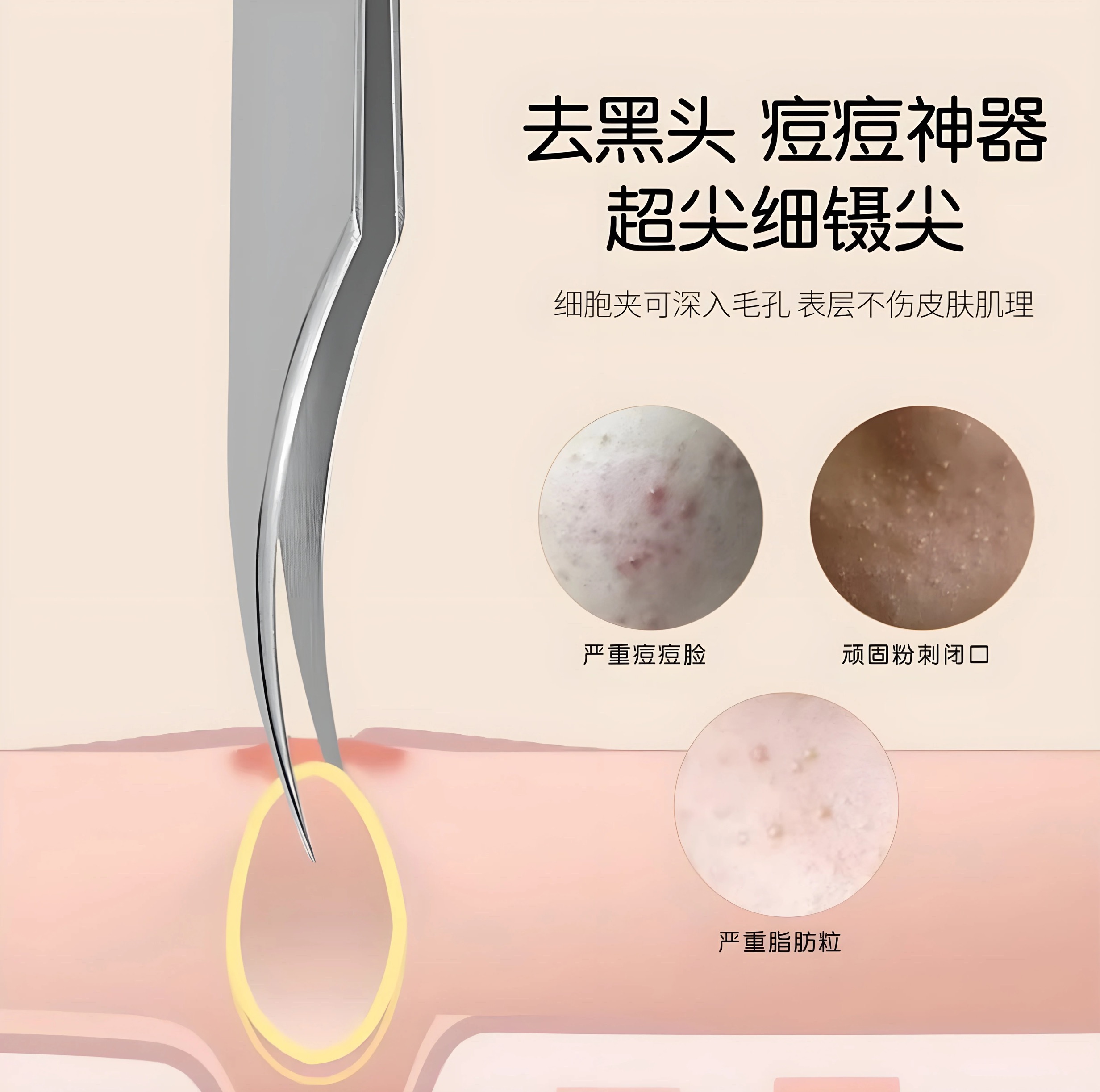 新款超尖去黑头镊子美容院专用