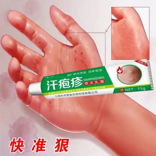 汗泡疱疹药膏手上起小水泡汗状疱疹止痒汉状真菌感染手气专用软膏