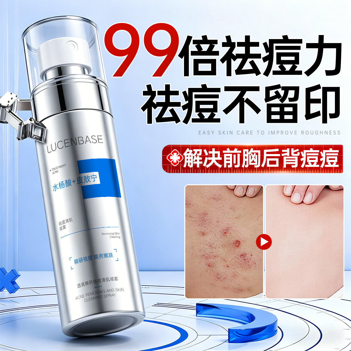 后背祛痘喷雾去除背上痘痘前胸口美背部水杨果酸痘印身体长痘除螨