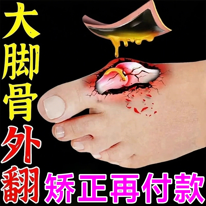 【已冶好10万人】拇指外翻膏贴
