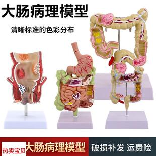 结肠病变模型 大肠病理模型 h肠胃模型 大肠病变模型 肠道疾病