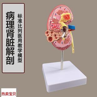 人体肾解剖模型病变肾脏模型人体器官F解剖模型病变内脏医院教学