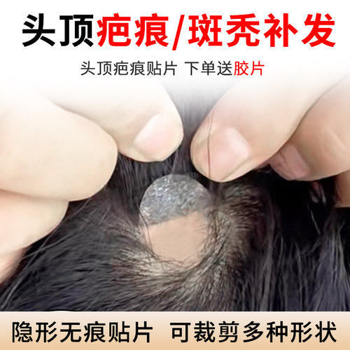 健康真人发丝生物头皮疤痕补发
