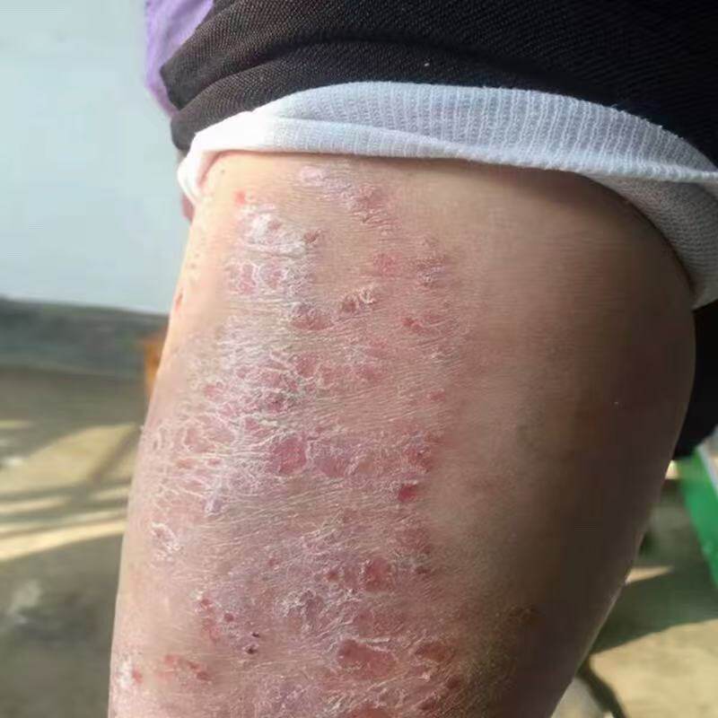 顽皮藓专用皮肤牛皮藓湿神经性皮炎疹止全身瘙痒股体手藓特效膏药