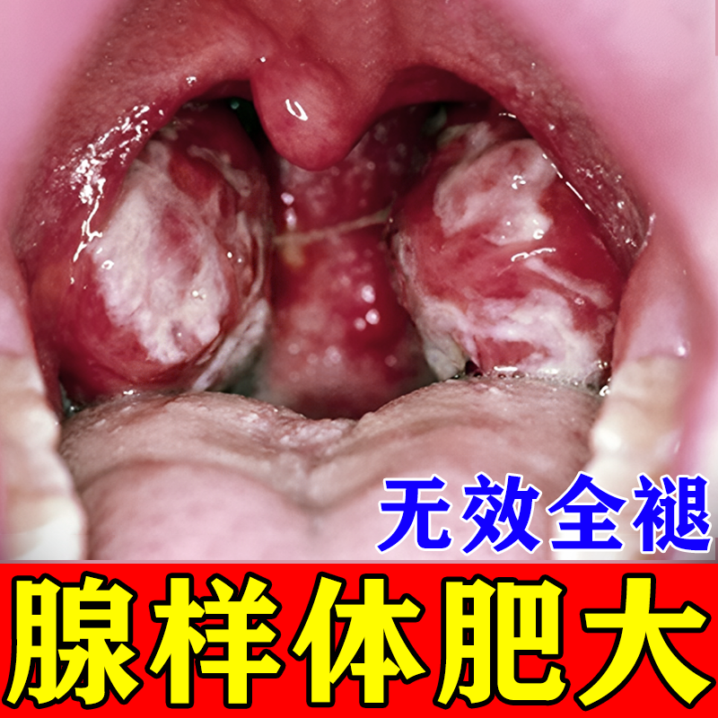 腺样体肥大泡脚中药包张嘴呼吸打呼噜面容矫正器儿童嘴唇上翘克星